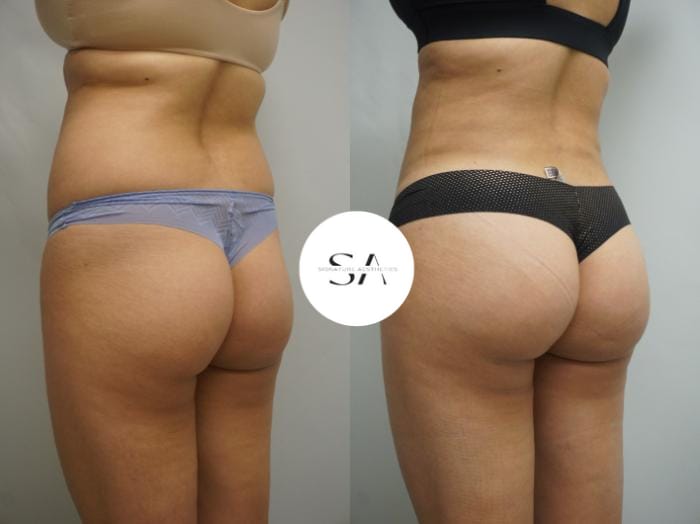 Say goodbye to Cellulite