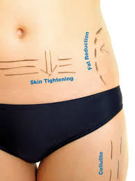 3D Lipo plus Emsculpt combo single session