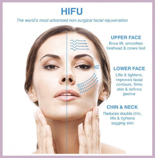 3D Ultimate: HIFU Upper Face Treatment (brow lift & crows feet)