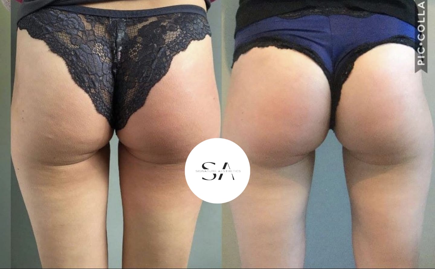 Say goodbye to Cellulite