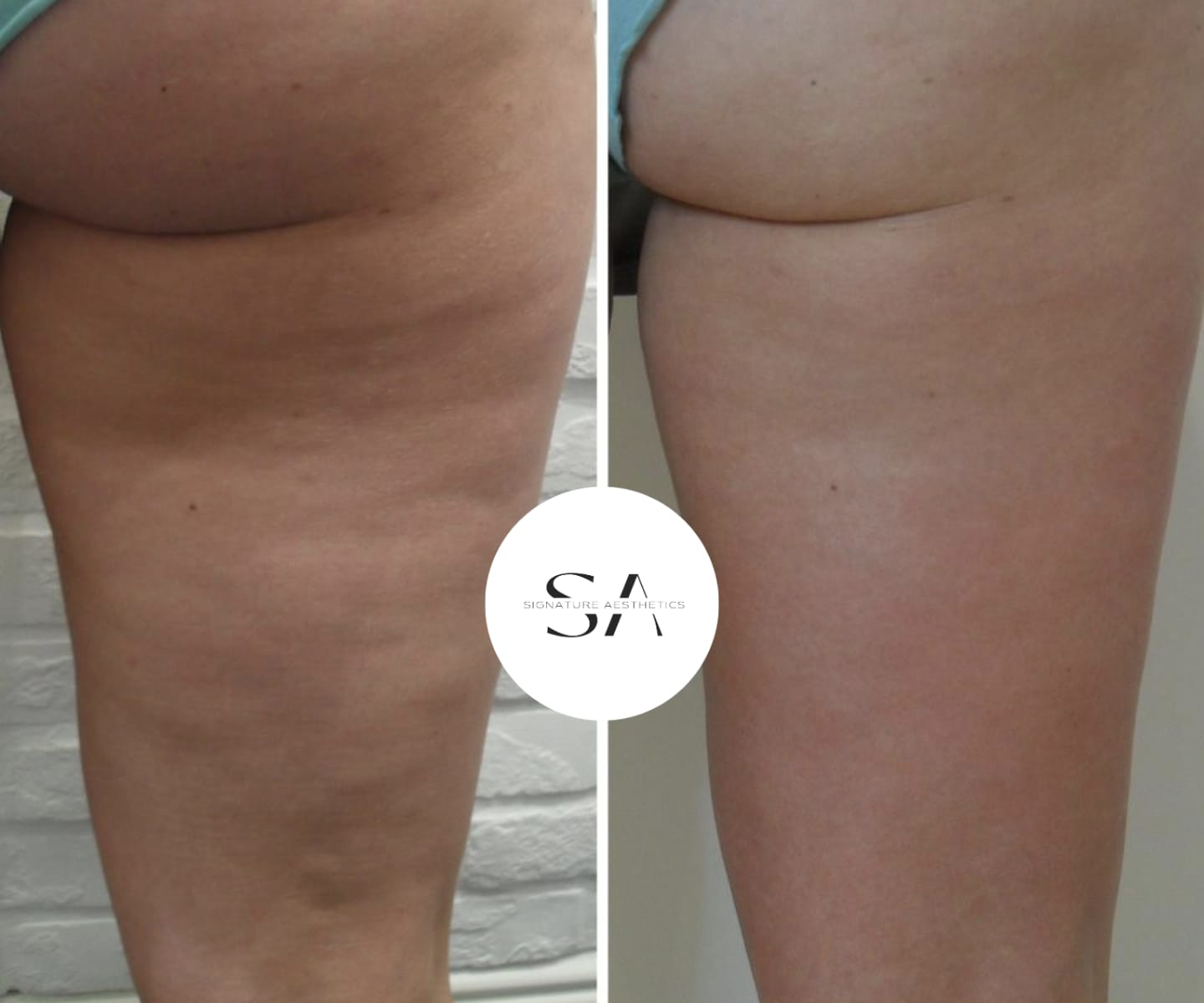 Say goodbye to Cellulite
