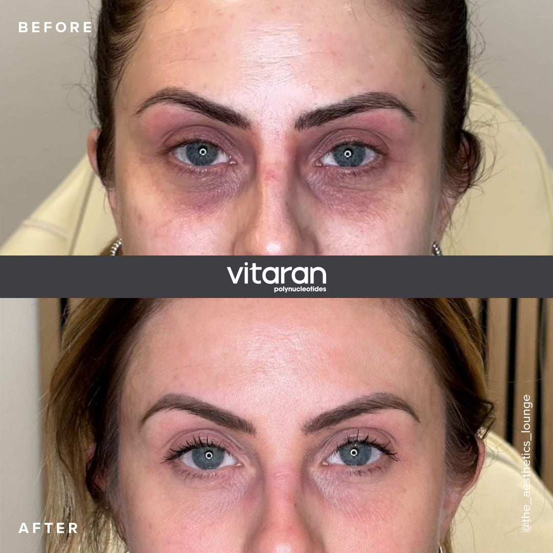 Injectables: Polynucleotides, Under eye treatment with Vitaran Eyes. Block of 3 sessions.