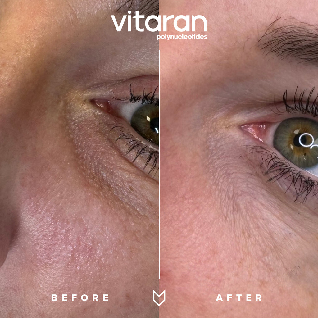 Injectables: Polynucleotides, Under eye treatment with Vitaran Eyes. Block of 3 sessions.