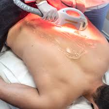 Laser hair removal Back (Full) course of 8